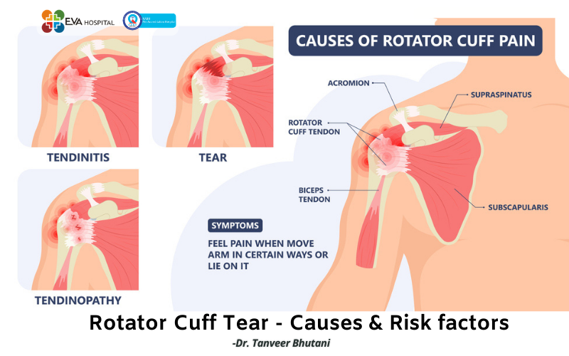 Rotator Cuff tear - Causes & Risk factors